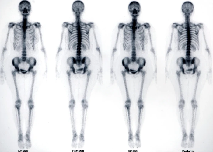 L'image résultant d'une scinthigraphie osseuse