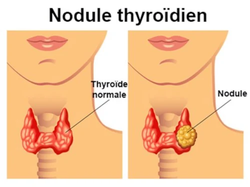 Les symptômes de l'hypothyroïdie